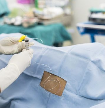 Epidural para el alivio del dolor después de la cirugía
