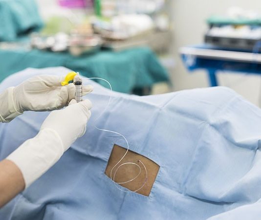 Epidural para el alivio del dolor después de la cirugía
