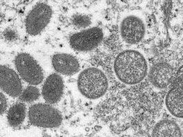 El brote de viruela del mono llega a más de 250 casos confirmados en todo el mundo
