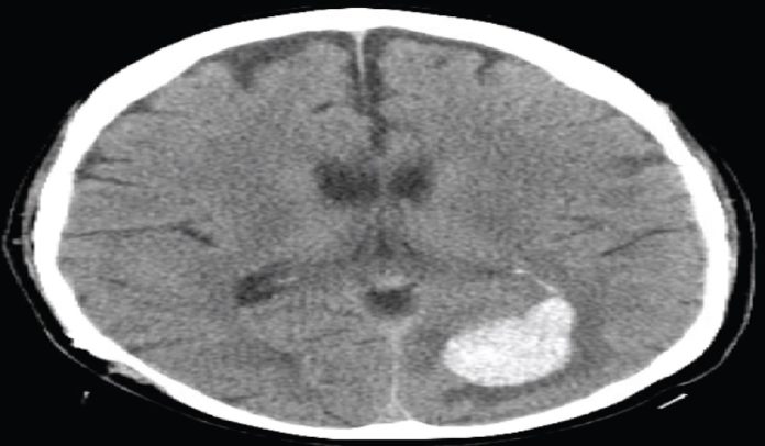 Consulta Rápida: Síntomas: Pérdida de Visión Periférica y H... : Emergency Medicine News
