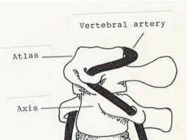 Manipulaciones quiroprácticas del cuello en las noticias
