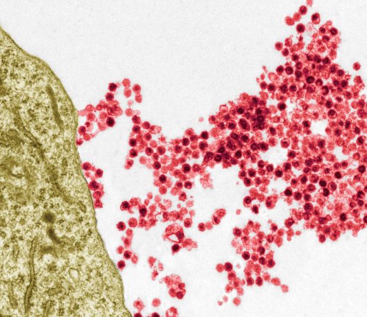 Multiple sclerosis has a common viral culprit, sparking new approaches Multiple sclerosis has a common viral culprit, sparking new approaches