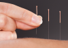 acupuncture Beverly Hills