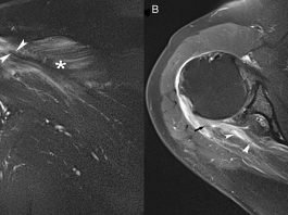 A-23-year-old-man-presented-with-pain-in-the-right-shoulder-after-an-intense-weight-lifting-workout.