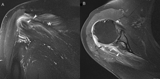 A-23-year-old-man-presented-with-pain-in-the-right-shoulder-after-an-intense-weight-lifting-workout.