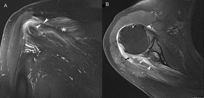 A-23-year-old-man-presented-with-pain-in-the-right-shoulder-after-an-intense-weight-lifting-workout.