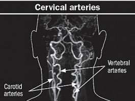 Dolor de cuello severo: ¿una señal de algo serio?

