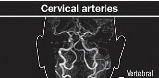 Dolor de cuello severo: ¿una señal de algo serio?
