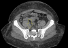 Computed-tomography-of-the-pelvis-showing-a-lytic-mass-within-the-right-sacrum-with-involved-sacral-neural-foramen-and-anterior-cortical-erosion.