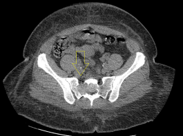 Computed-tomography-of-the-pelvis-showing-a-lytic-mass-within-the-right-sacrum-with-involved-sacral-neural-foramen-and-anterior-cortical-erosion.