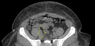 Computed-tomography-of-the-pelvis-showing-a-lytic-mass-within-the-right-sacrum-with-involved-sacral-neural-foramen-and-anterior-cortical-erosion.