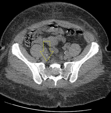 Computed-tomography-of-the-pelvis-showing-a-lytic-mass-within-the-right-sacrum-with-involved-sacral-neural-foramen-and-anterior-cortical-erosion.