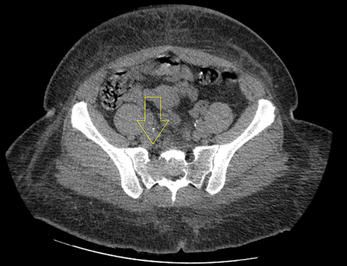 Computed-tomography-of-the-pelvis-showing-a-lytic-mass-within-the-right-sacrum-with-involved-sacral-neural-foramen-and-anterior-cortical-erosion.