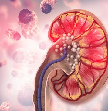 The Simplest Way to Flush Kidney Stones, Other Stones out of the Body