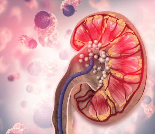 The Simplest Way to Flush Kidney Stones, Other Stones out of the Body