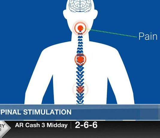 El estimulador espinal detiene el dolor del nervio diabético El estimulador espinal detiene el dolor del nervio diabético