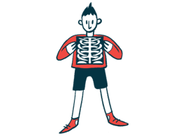 Los huesos más débiles de Hypermobile EDS pueden ser impulsados por una actividad limitada | Ejercicio Favorecido para Reducir el Riesgo de Fractura Ósea Los huesos más débiles de Hypermobile EDS pueden ser impulsados por una actividad limitada | Ejercicio Favorecido para Reducir el Riesgo de Fractura Ósea