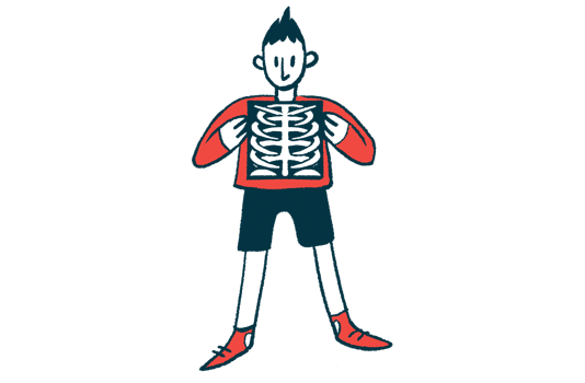  Los huesos más débiles de Hypermobile EDS pueden ser impulsados ​​​​por una actividad limitada |  Ejercicio Favorecido para Reducir el Riesgo de Fractura Ósea
