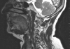 Preoperative-MRI-(T2-sagittal)-showing-a-well-defined-extradural-and-ventrodorsal-lesion-causing-severe-impingement-of-the-spinal-cord-(arrow).