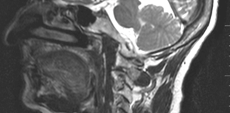Preoperative-MRI-(T2-sagittal)-showing-a-well-defined-extradural-and-ventrodorsal-lesion-causing-severe-impingement-of-the-spinal-cord-(arrow).