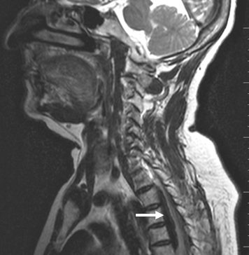 Preoperative-MRI-(T2-sagittal)-showing-a-well-defined-extradural-and-ventrodorsal-lesion-causing-severe-impingement-of-the-spinal-cord-(arrow).
