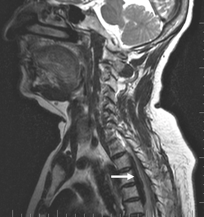 Preoperative-MRI-(T2-sagittal)-showing-a-well-defined-extradural-and-ventrodorsal-lesion-causing-severe-impingement-of-the-spinal-cord-(arrow).