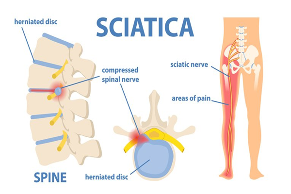 Sciatica is the most frequent nerve pain Rising Kashmir