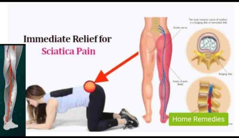 Immediate Relief For Sciatica Pain At Home