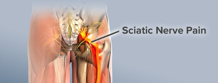 What Causes The Sciatic Nerve To Flare Up?