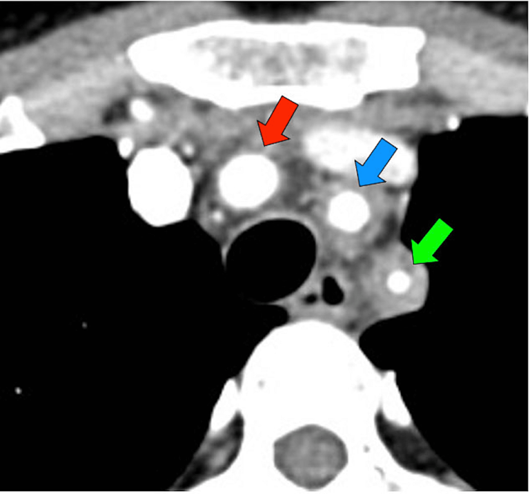 Linear neck pain and chronic cough caused by Takayasu Arteritis Cureus