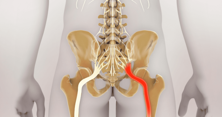 Research suggests vulnerability of Sciatic Nerve to Hip Arthroplasty Study Supports Sciatic Nerve Vulnerability To Hip Arthroplasty Nation World News