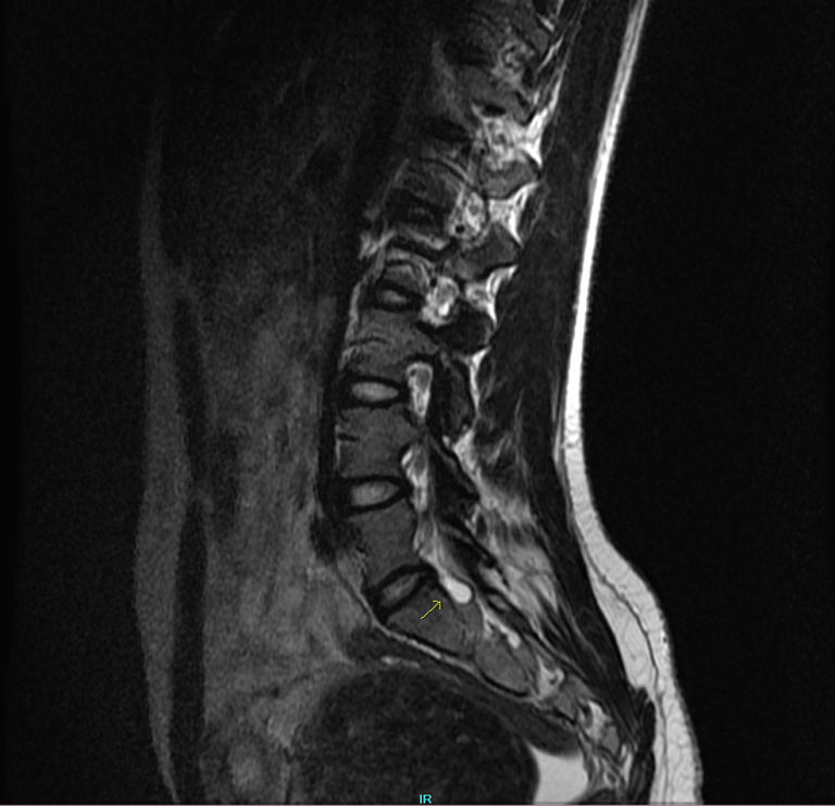 Sciatica during early pregnancy with co-existing Uterine The Leiomyoma as well as Tarlov Cyst Case Report Cureus