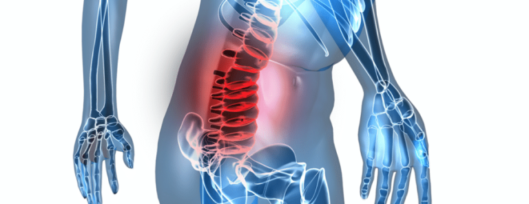 Can a Bulging Disc Cause Abdominal Pain