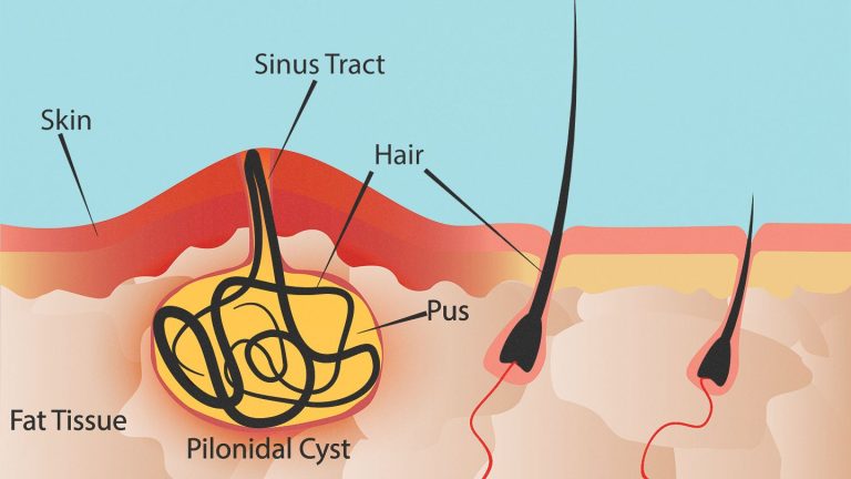 Can a Pilonidal Cyst Cause Back Pain