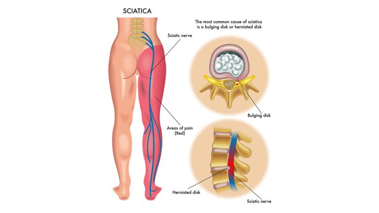 how does sciatica cause groin pain