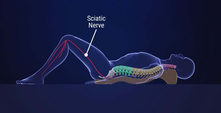 How Long Does It Take For Sciatic Nerve To Heal