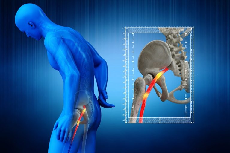 How To Fix Sciatica Pain Fast