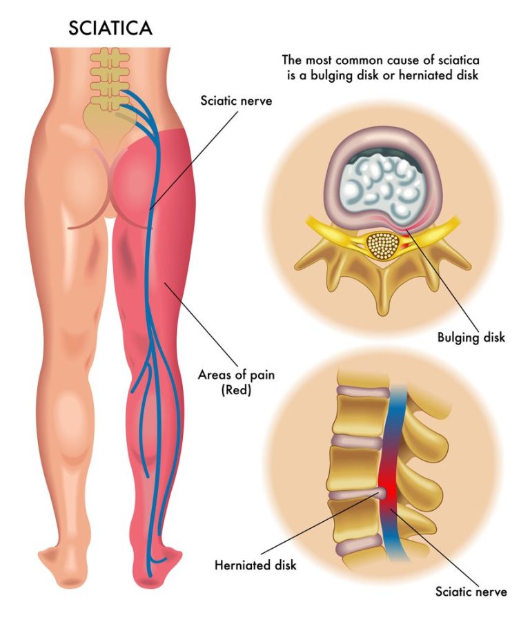 How To Prevent Sciatic Nerve Pain