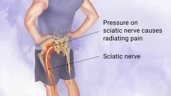 How To Get Sciatica To Stop Hurting