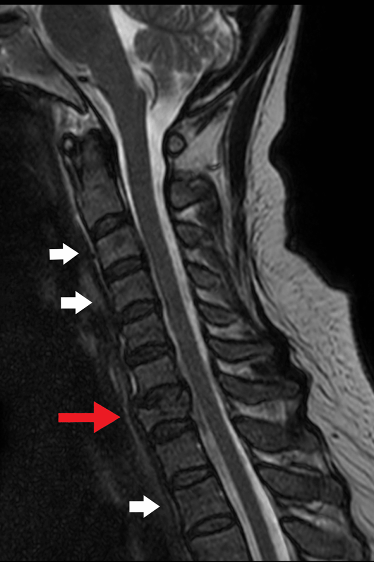 Thyroid Cancer Presenting As Neck Pain At A Chiropractic Clinic